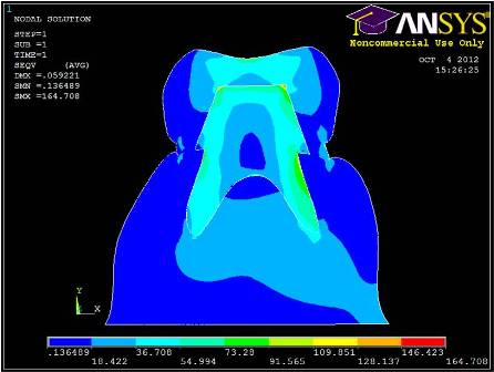FEM解析によるコアを装着した下顎第一大臼歯部の相当応力