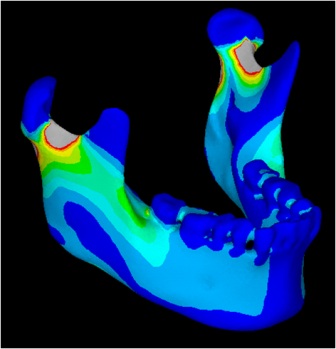 FEMによる顎骨の外力負荷後の相当応力分布